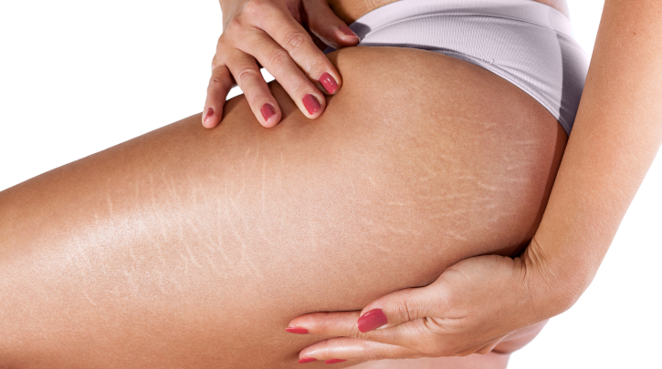 Stretch Mark Reduction with Venus Viva™ Skin Resurfacing