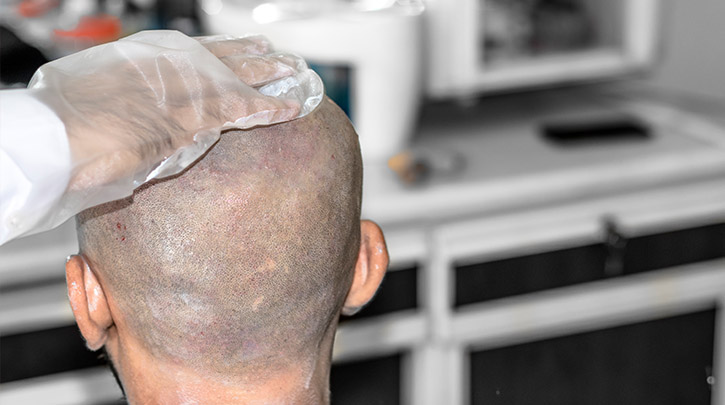 What makes the Neograft FUE Hair Transplant different?