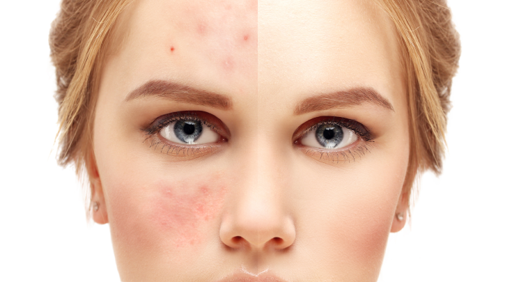 What Is Rosacea and How to Treat It