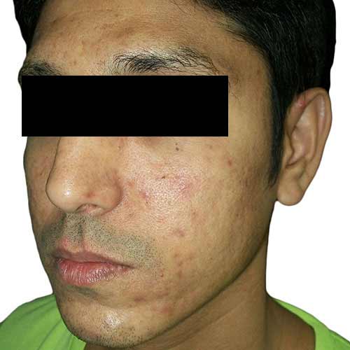 acne scar reduction - before