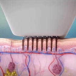 The Technology Behind the Venus Viva Tip Image 2