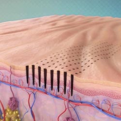The Technology Behind the Venus Viva Tip Image 3