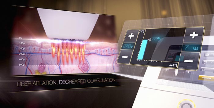 The Technology Behind the Venus Viva Tip