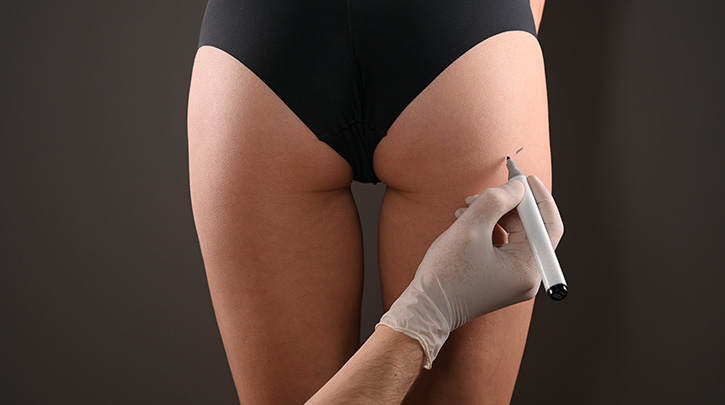 The Brazilian Butt Lift Trend - What to Tell Your Patients